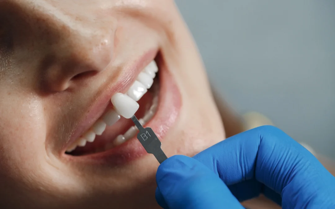 Types of Dental Veneers Available in Columbia, SC: Expert Guide