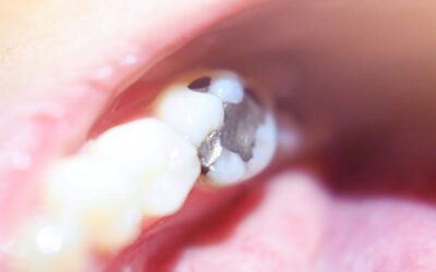 Silver Filling Replacement Process in Columbia, SC: What to Expect