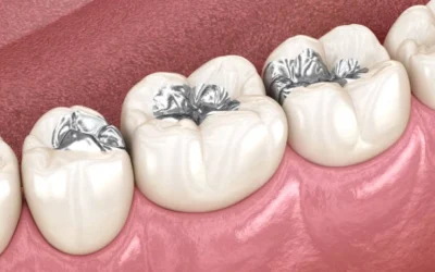 Health Benefits of Replacing Silver Fillings: Columbia Expert Review