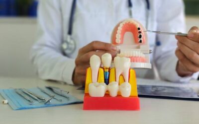 Step-by-Step Dental Implant Procedure Guide for Columbia, SC Patients