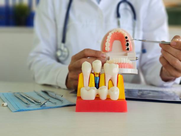 Step-by-Step Dental Implant Procedure Guide for Columbia, SC Patients