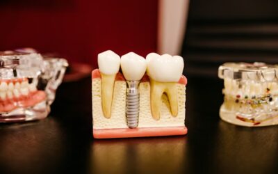 Are You a Candidate for Dental Implants in Columbia, SC? Expert Guide