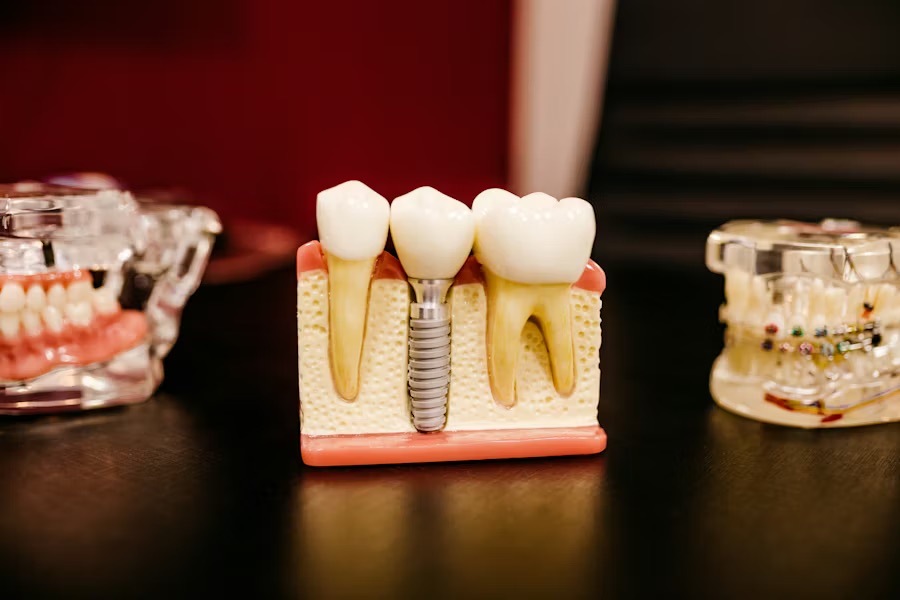 Are You a Candidate for Dental Implants in Columbia, SC? Expert Guide