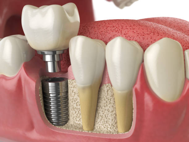How Dental Implants Prevent Bone Loss: Columbia Dentist Explains