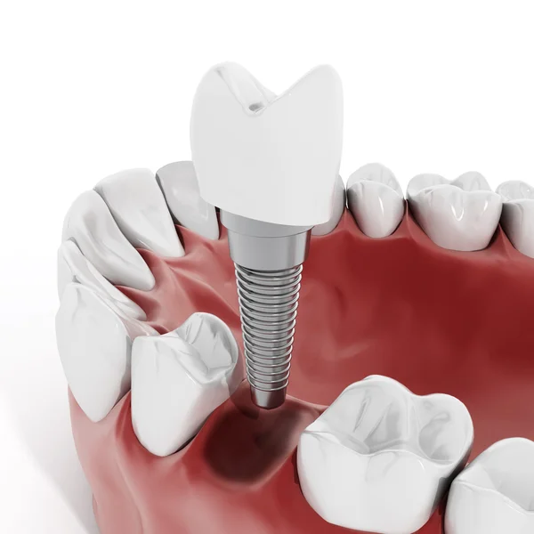 Dental Implant Benefits in Columbia for a Strong, Natural Smile